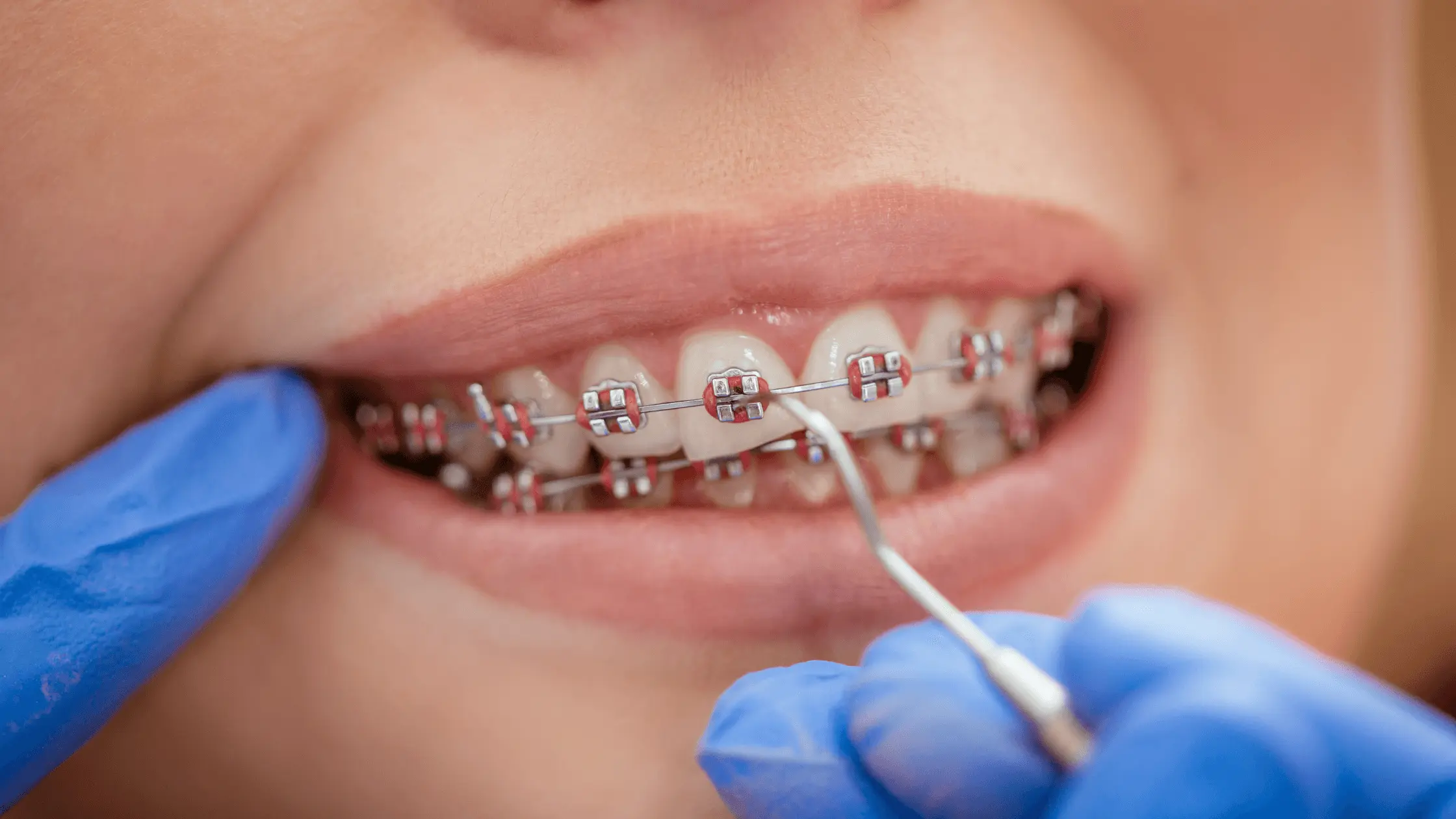 Photo of Everything You Need to Know About Power Chain Braces for Perfect Teeth